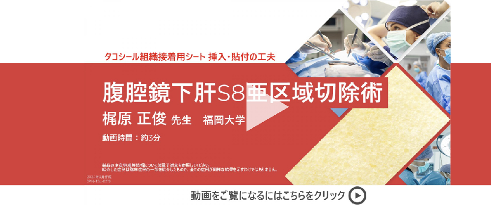 腹腔鏡下肝S8亜区域切除 右肝静脈分枝の出血部位の閉鎖処置にタコシールを使用した症例