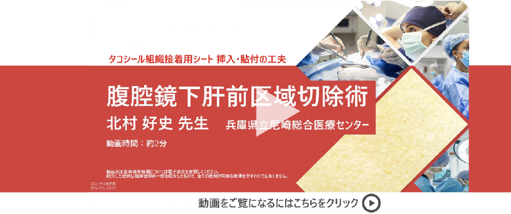 腹腔鏡下肝前区域切除時に損傷した右肝静脈からの出血部位の閉鎖処置にタコシールを使用した症例