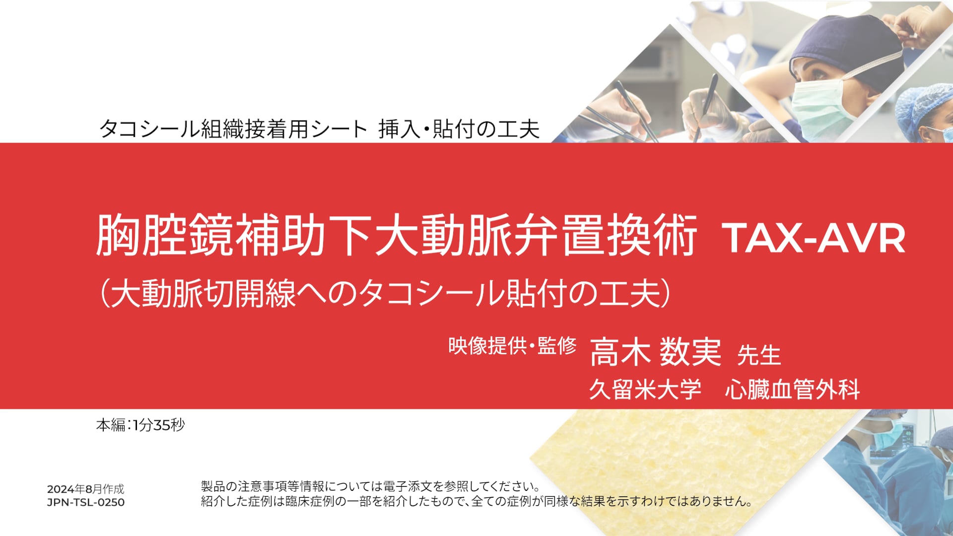 胸腔鏡補助下大動脈置換術 TAX-AVR（大動脈切開線へのタコシール貼付の工夫）